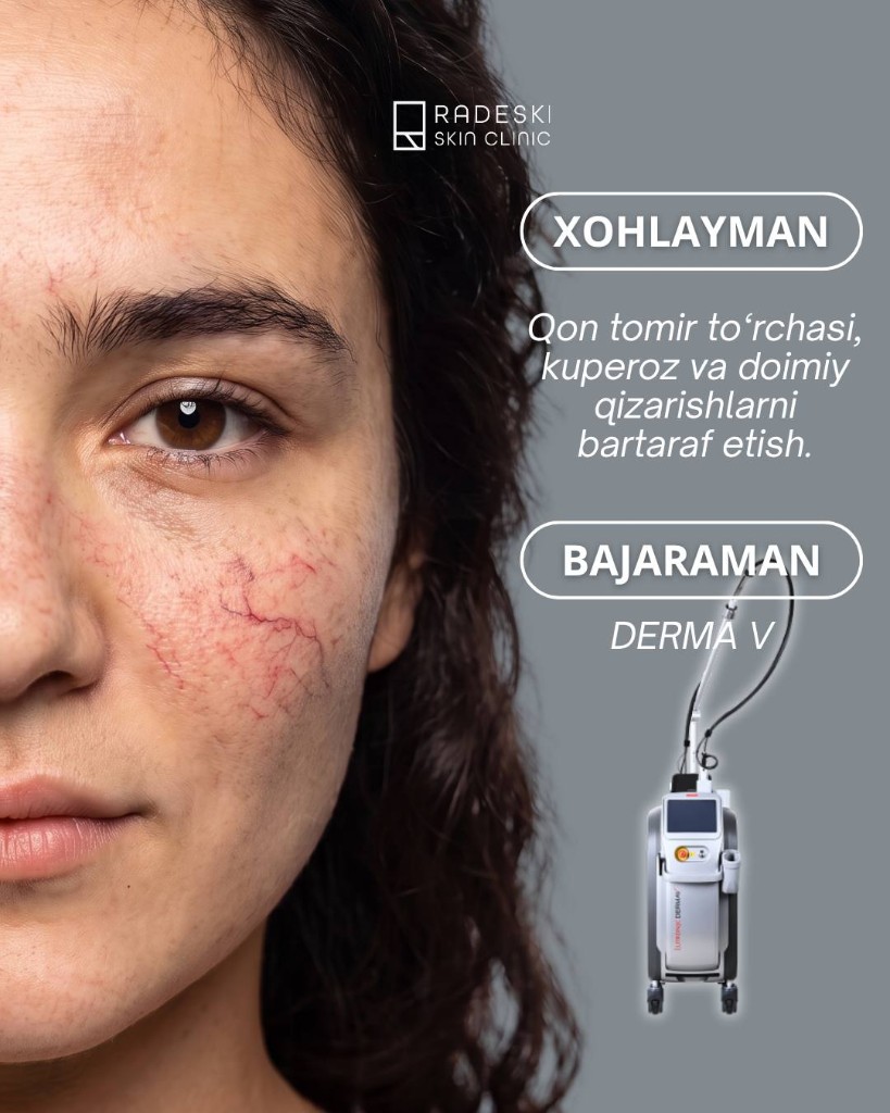 Lutronic Derma V — лечение сосудов и покраснения