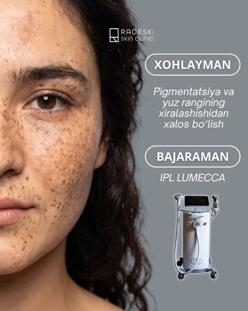 IPL Lumecca — treating pigmentation and brightening skin tone