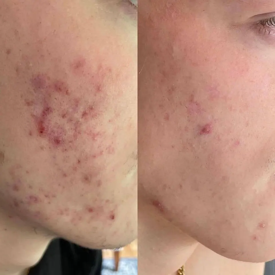 Kattalarda akne: sabablari, davolash va qachon dermatologga murojaat qilish kerak
