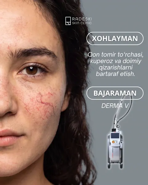 Derma V (Lutronic) in Fergana and Kokand