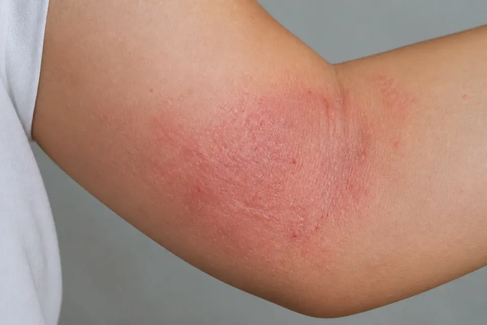 Eczema: Types, Causes and Treatment — Red, Weeping and Itchy Skin