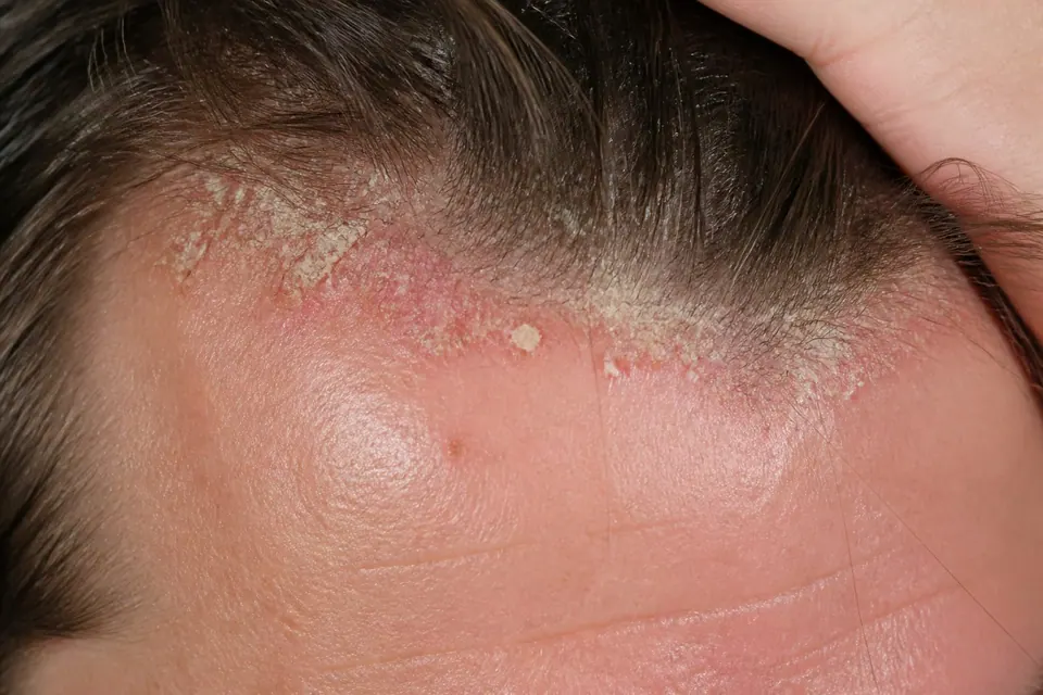 Seboreyali dermatit: sabablari, belgilari va davolash — kepak, yuz va qoshdagi qizarish
